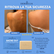 Dermelia Bacne Out
