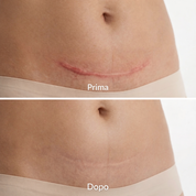 DERMELIA™ Repair - Il primo trattamento a barriera prolungata per ogni tipo di cicatrice